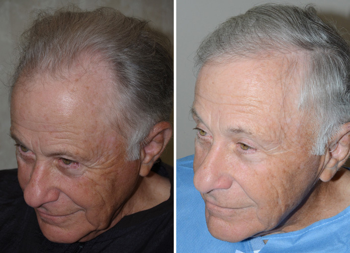 Hair Transplants for Men Before and after in Miami, FL, Paciente 38919