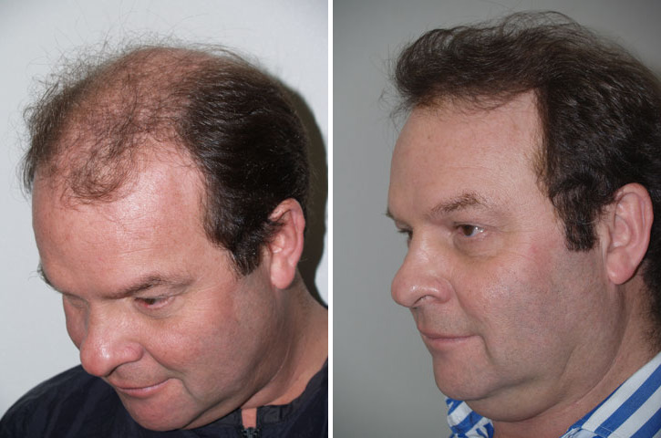 Hair Transplants for Men Before and after in Miami, FL, Paciente 38939