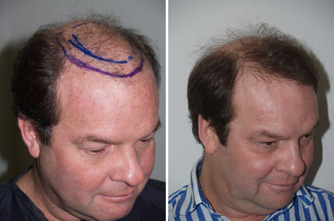 Hair Transplants for Men Before and after in Miami, FL, Paciente 38939