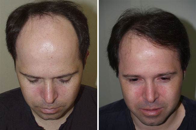 Hair Transplants for Men Before and after in Miami, FL, Paciente 38955