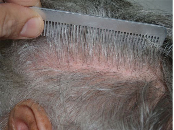 Hair Transplants for Men Before and after in Miami, FL, Paciente 38975