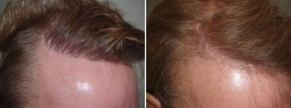 Reparative Hair Transplant Before and after in Miami, FL, Paciente 39010