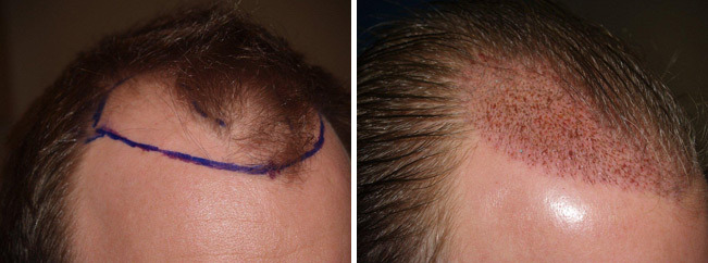 Hair Transplants for Men Before and after in Miami, FL, Paciente 39021