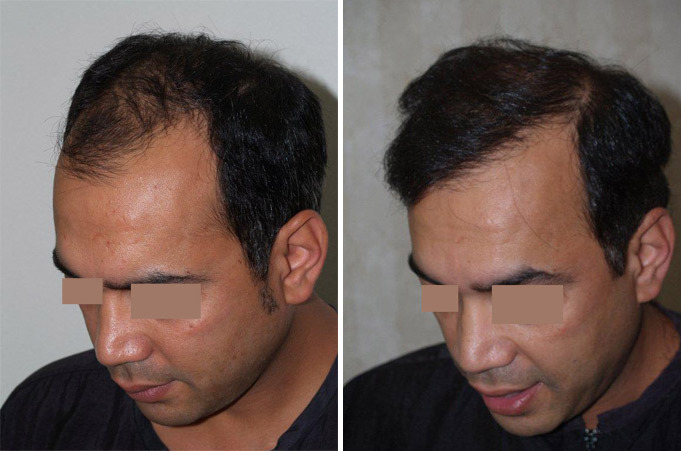 Hair Transplants for Men Before and after in Miami, FL, Paciente 39282