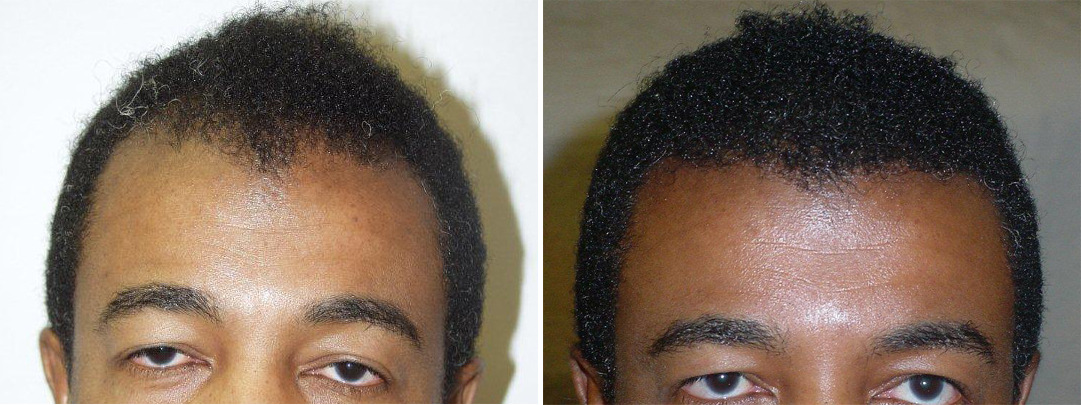Hair Transplants for Men Before and after in Miami, FL, Paciente 39379