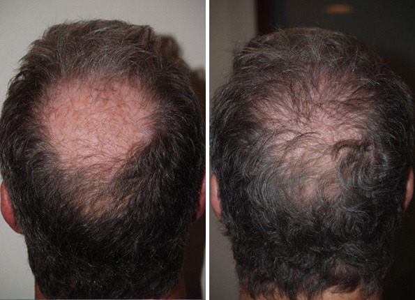 Hair Transplants for Men Before and after in Miami, FL, Paciente 39687
