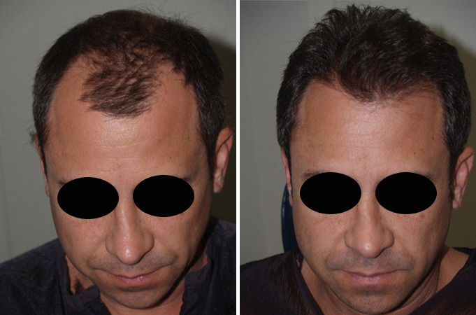 Hair Transplants for Men Before and after in Miami, FL, Paciente 39916