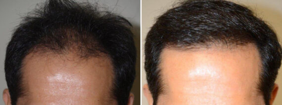 Hair Transplants for Men Before and after in Miami, FL, Paciente 39960