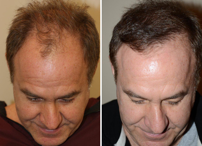 Hair Transplants for Men Before and after in Miami, FL, Paciente 40095