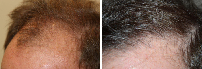 Hair Transplants for Men Before and after in Miami, FL, Paciente 40095