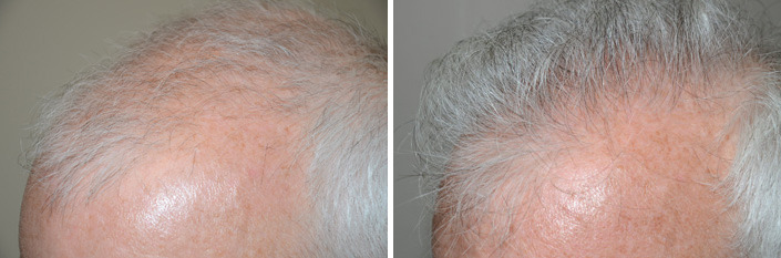 Hair Transplants for Men Before and after in Miami, FL, Paciente 40106