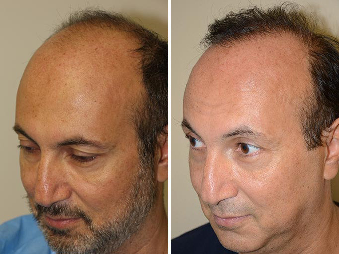 Hair Transplants for Men Before and after in Miami, FL, Paciente 40123