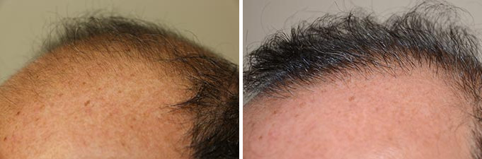 Hair Transplants for Men Before and after in Miami, FL, Paciente 40123