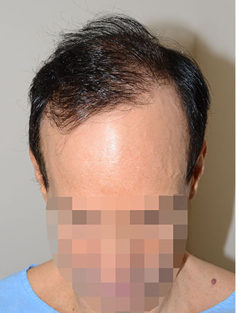 Hair Transplants for Men Before and after in Miami, FL, Paciente 40144