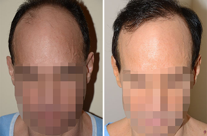 Hair Transplants for Men Before and after in Miami, FL, Paciente 40144