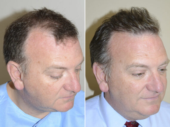 Hair Transplants for Men Before and after in Miami, FL, Paciente 40182