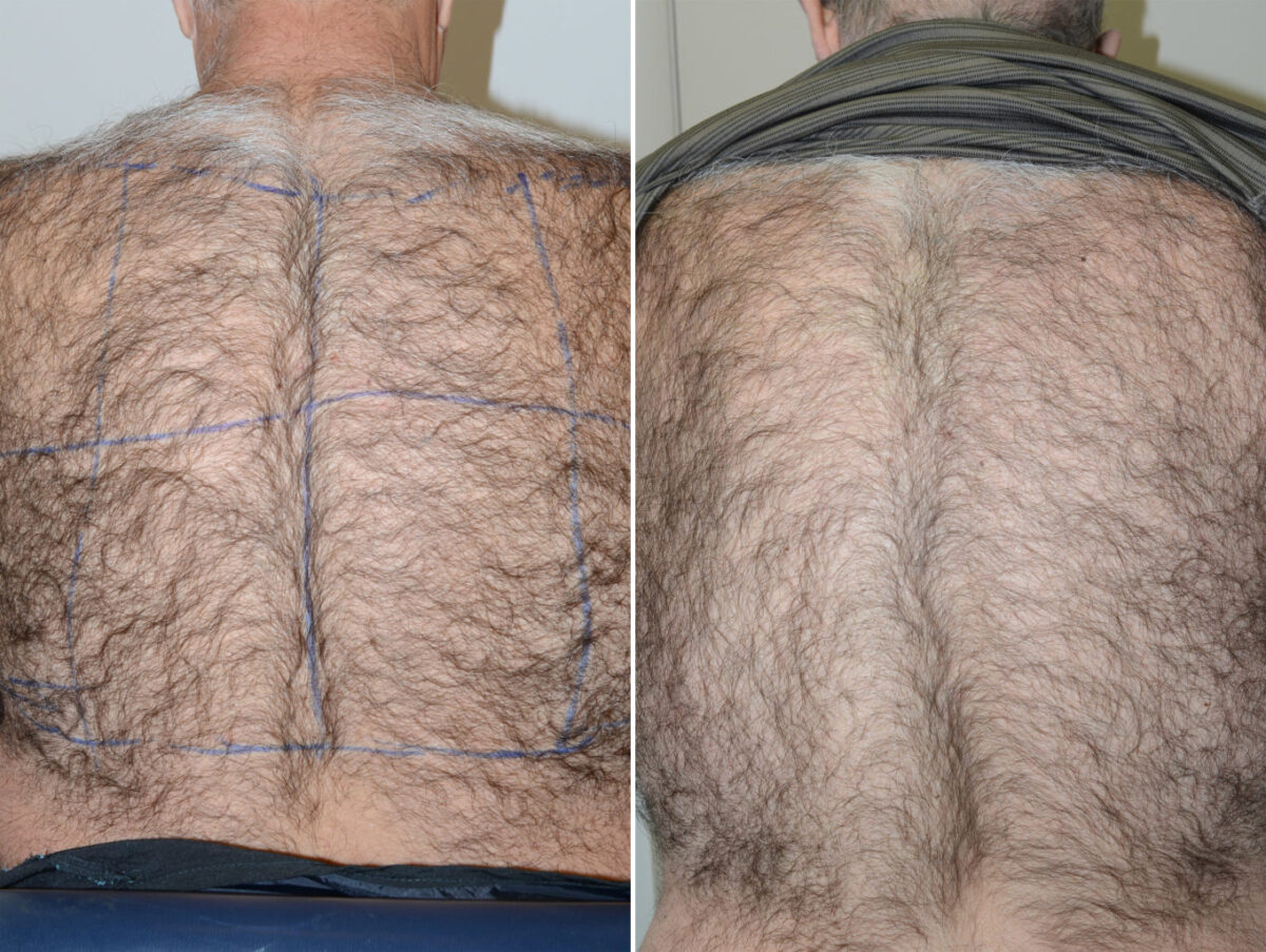 Body Hair Transplant Before and after in Miami, FL, Paciente 40189