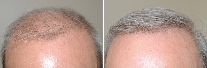 Body Hair Transplant Before and after in Miami, FL, Paciente 40189