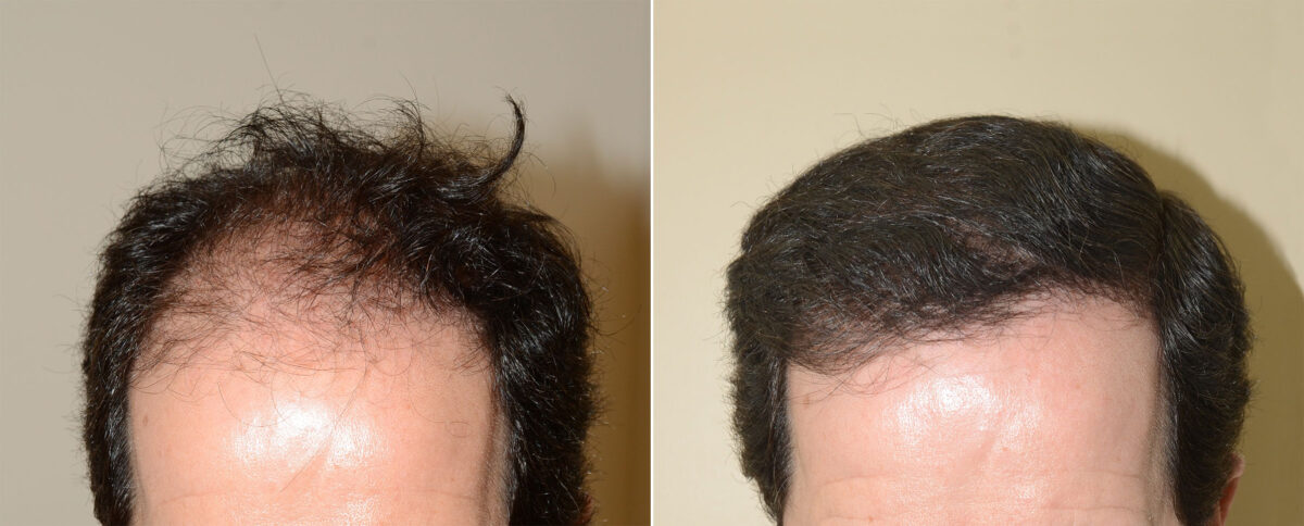 Hair Transplants for Men Before and after in Miami, FL, Paciente 47693