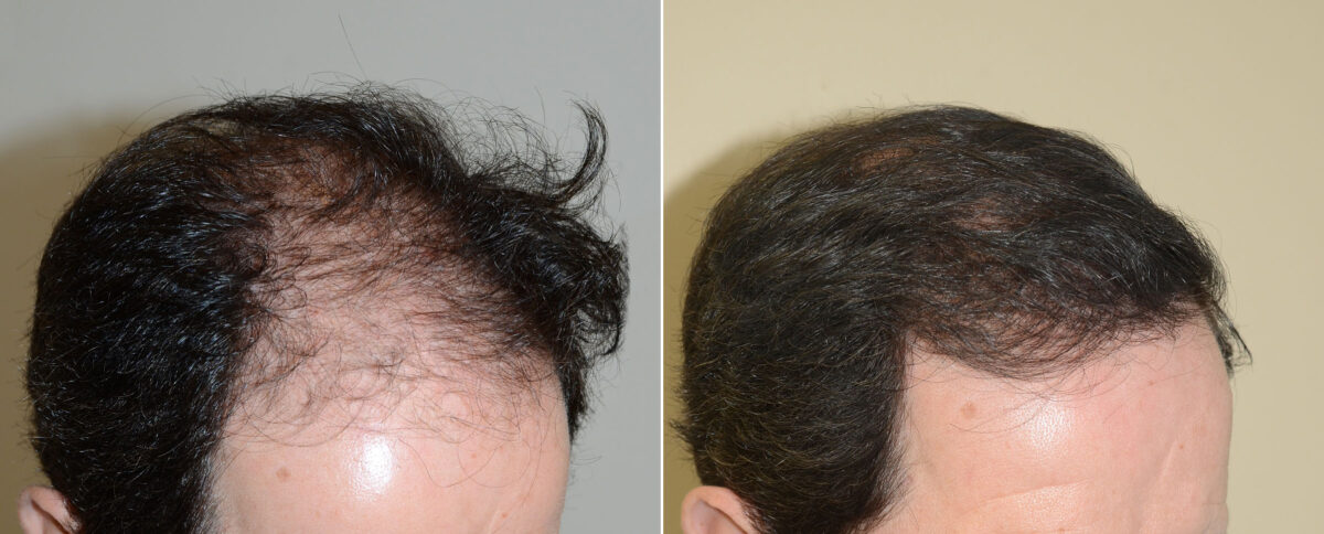 Hair Transplants for Men Before and after in Miami, FL, Paciente 47693