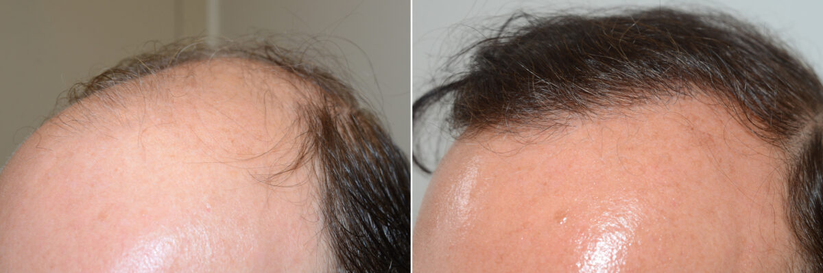 Hair Transplants for Men Before and after in Miami, FL, Paciente 57908