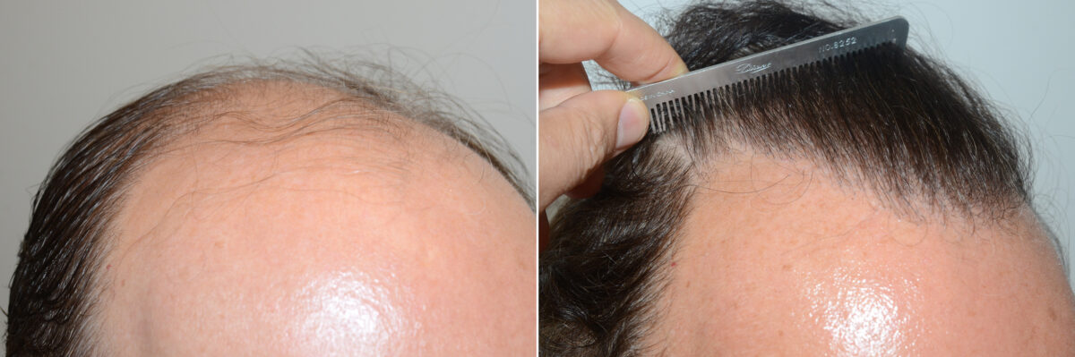 Hair Transplants for Men Before and after in Miami, FL, Paciente 57908