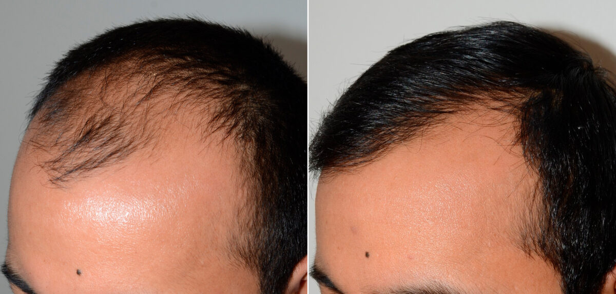 Hair Transplants for Men Before and after in Miami, FL, Paciente 58627