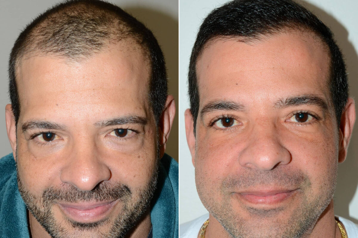 Hair Transplants for Men Before and after in Miami, FL, Paciente 58764
