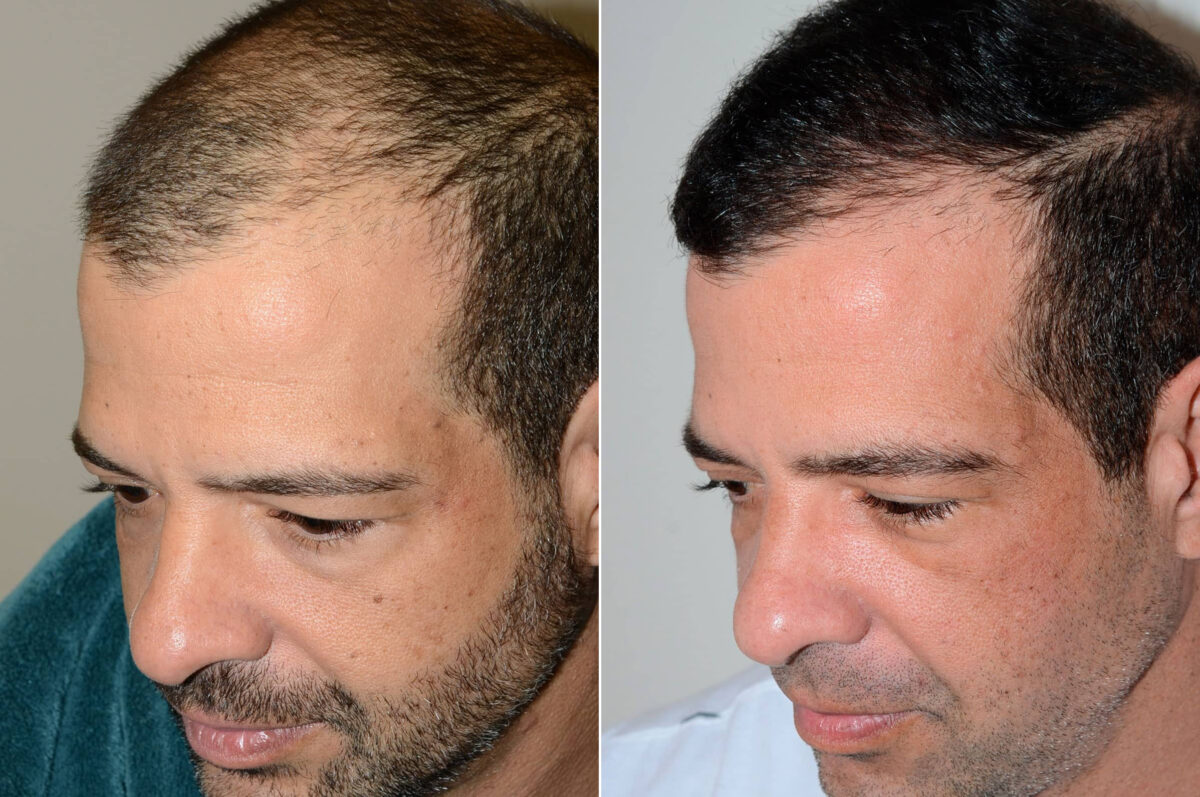 Hair Transplants for Men Before and after in Miami, FL, Paciente 58764