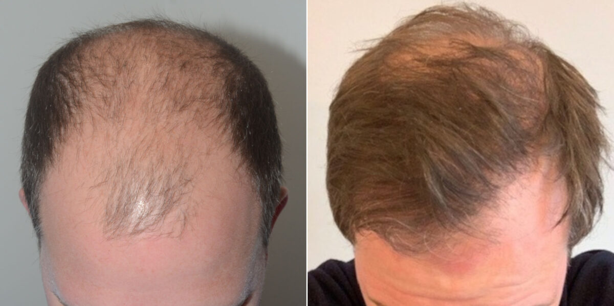 Hair Transplants for Men Before and after in Miami, FL, Paciente 58925