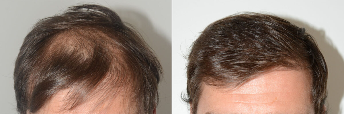 Hair Transplants for Men Before and after in Miami, FL, Paciente 59512
