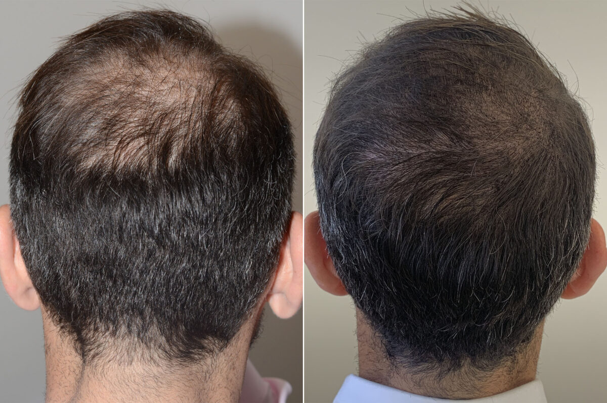 Hair Transplants for Men Before and after in Miami, FL, Paciente 59563