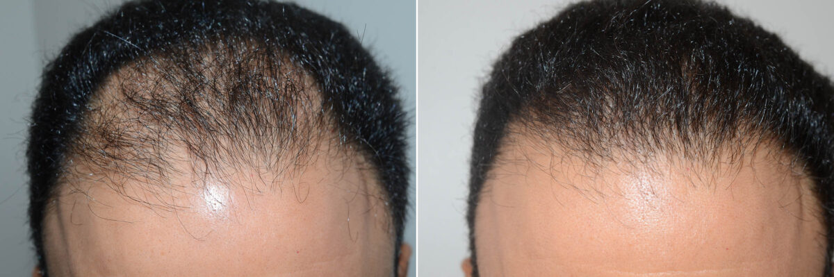 Hair Transplants for Men Before and after in Miami, FL, Paciente 59605