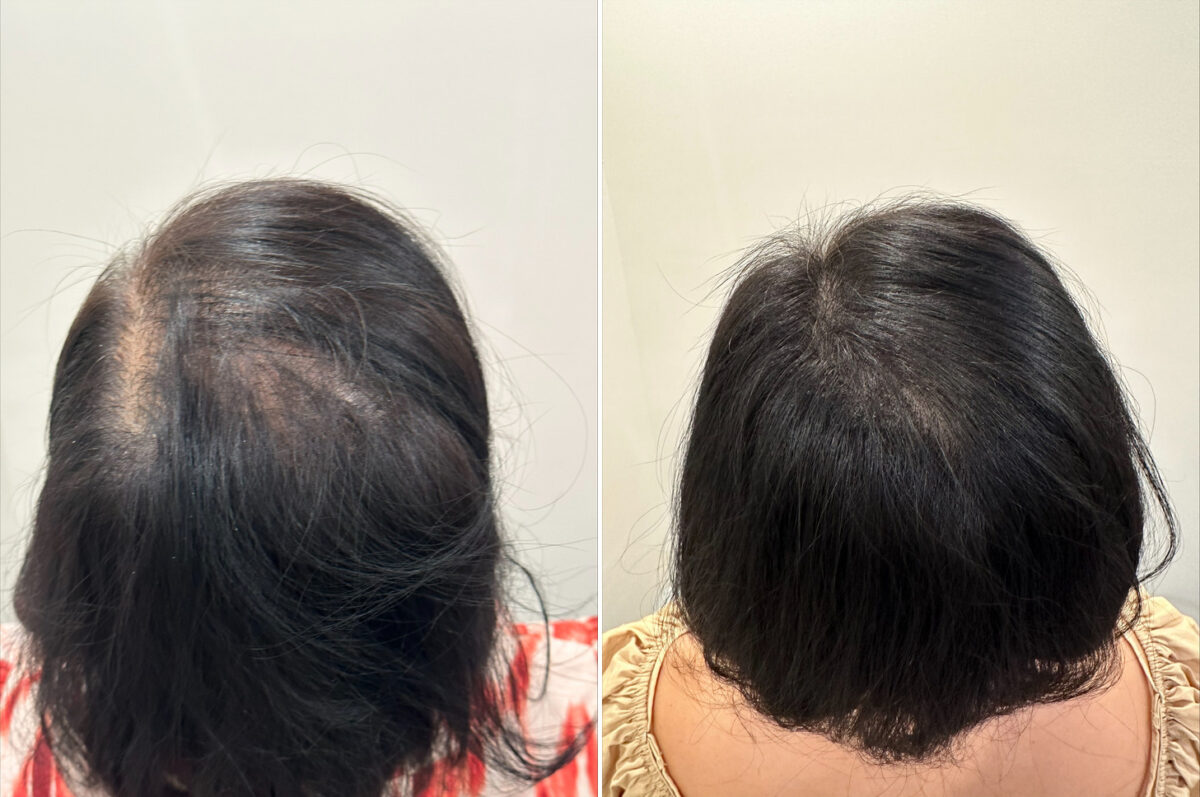 Scalp Micropigmentation Before and after in Miami, FL, Paciente 125295
