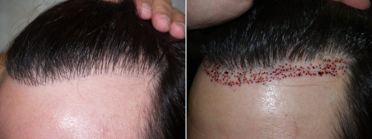 Reparative Hair Transplant Before and after in Miami, FL, Paciente 125320