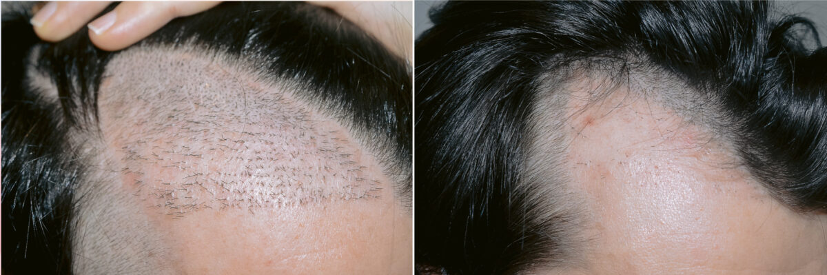 Reparative Hair Transplant Before and after in Miami, FL, Paciente 125332