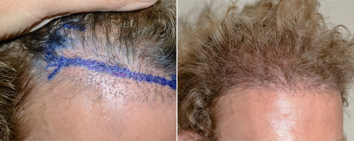 Hair Transplants for Men Before and after in Miami, FL, Paciente 125339