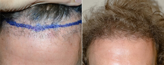 Hair Transplants for Men Before and after in Miami, FL, Paciente 125339