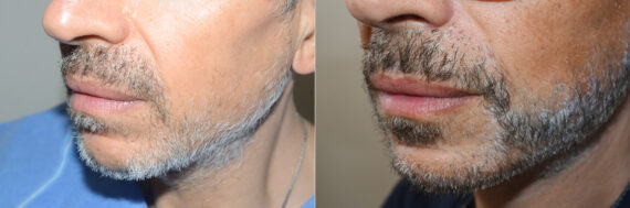 Facial Hair Transplant Before and after in Miami, FL, Paciente 125432