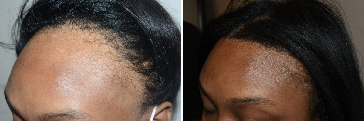 Forehead Reduction Surgery Before and after in Miami, FL, Paciente 125490