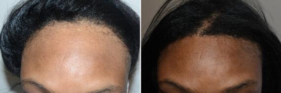 Forehead Reduction Surgery Before and after in Miami, FL, Paciente 125490