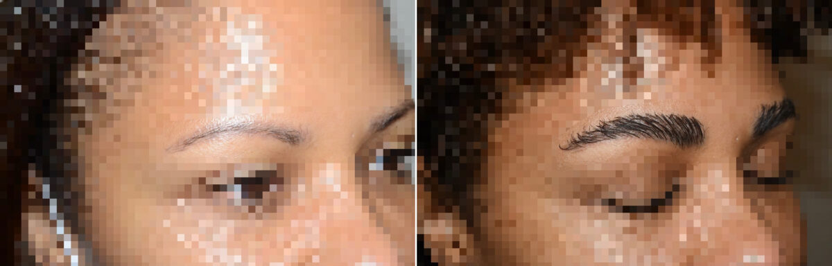 Eyebrow Hair Transplant Before and after in Miami, FL, Paciente 125516