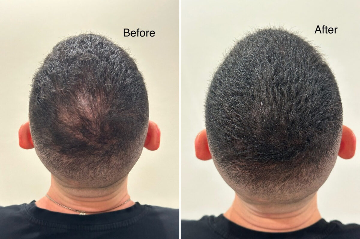 Scalp Micropigmentation Before and after in Miami, FL, Paciente 125565