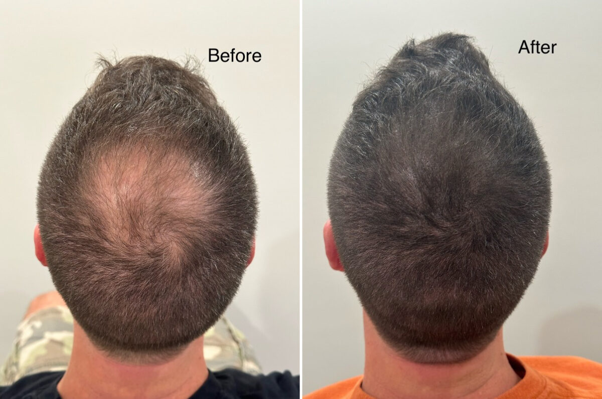 Scalp Micropigmentation Before and after in Miami, FL, Paciente 125572