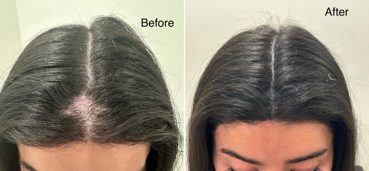 Scalp Micropigmentation Before and after in Miami, FL, Paciente 125579
