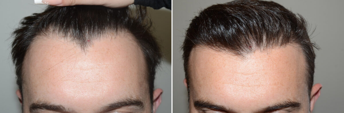 Hair Transplants for Men Before and after in Miami, FL, Paciente 125601