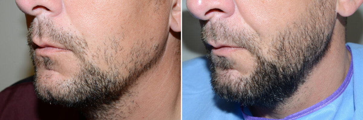 Facial Hair Transplant Before and after in Miami, FL, Paciente 125620