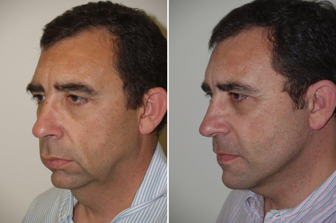 Facial Plastic Surgery Before and after in , , Paciente 125668