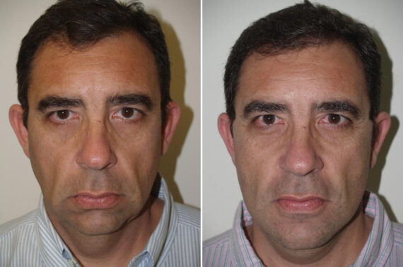 Facial Plastic Surgery Before and after in , , Paciente 125668