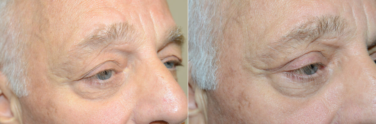 Facial Plastic Surgery Before and after in Miami, FL, Paciente 125679